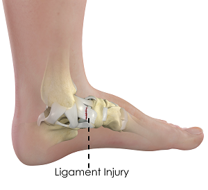 What is a Ligament Injury ?