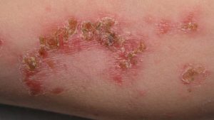 Bacterial skin Infection