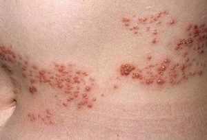 Viral Infections on skin 