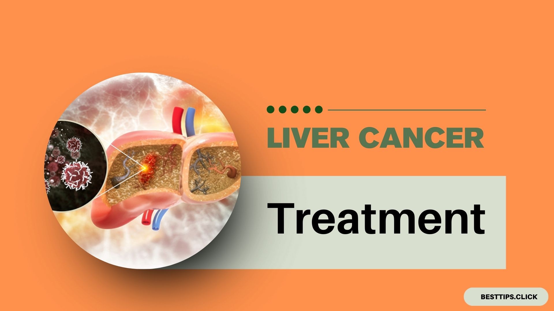 Liver Cancer Treatment